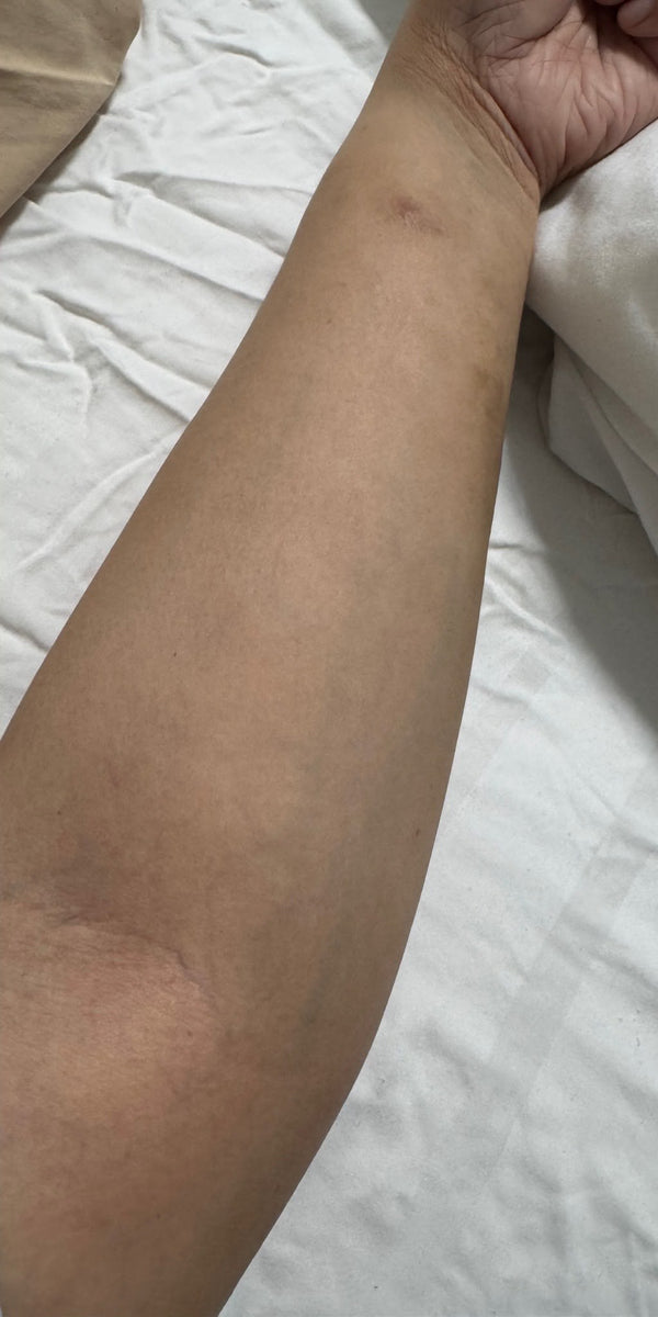 Forearm eczema, after SpiroPlus