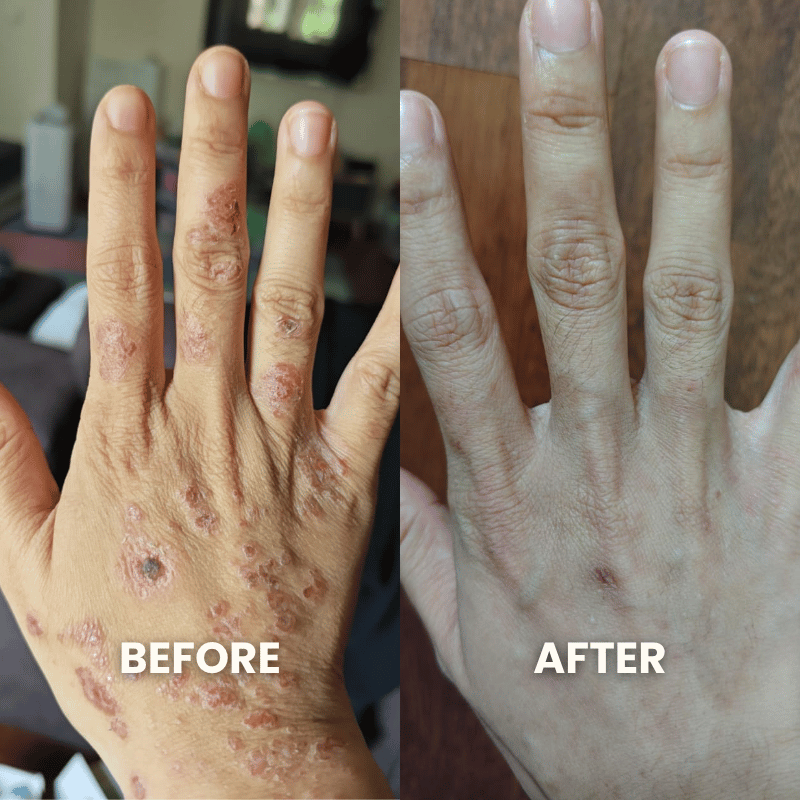 SpiroPlus (Natural Eczema & Psoriasis Solution Backed by Gut Science - Trusted in Singapore) - MakeHealth - Easier