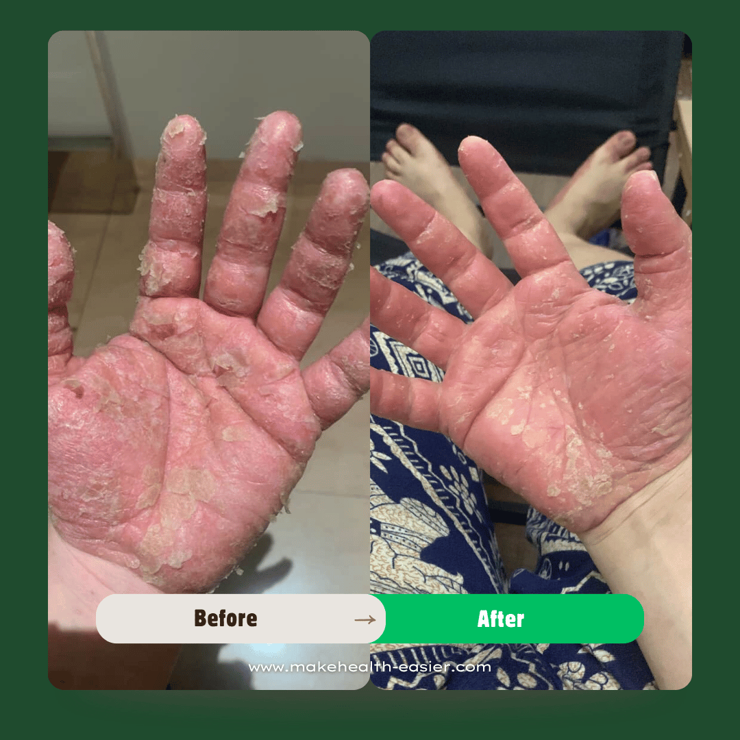 Are Eczema and Psoriasis Treated the Same? - MakeHealth-Easier