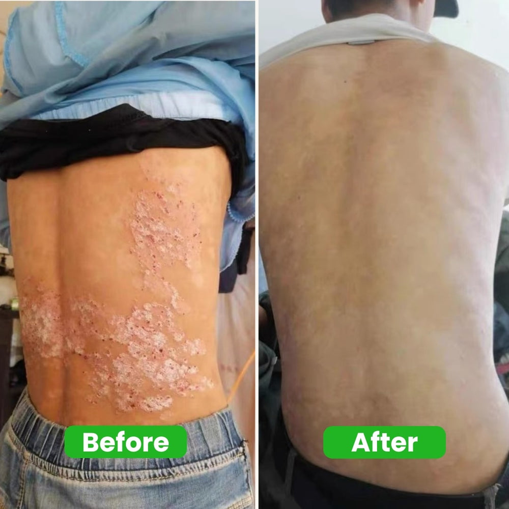 <p>Over 3,000 Singaporeans Have Finally Found Relief Without Steroids</p>