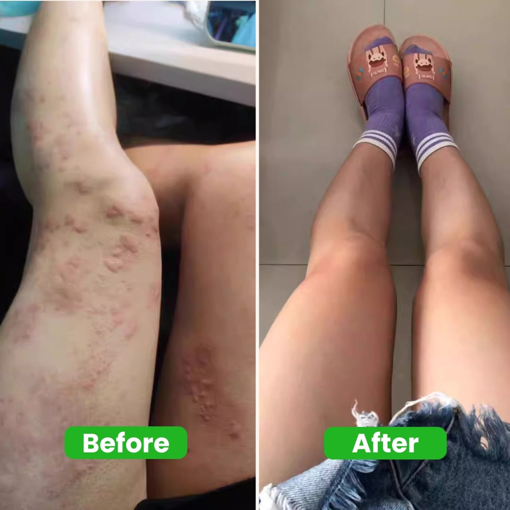 <p>Over 3,000 Singaporeans Have Finally Found Relief Without Steroids</p>