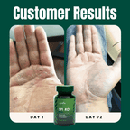 SpiroPlus (Eczema Solution Backed by Gut Science)