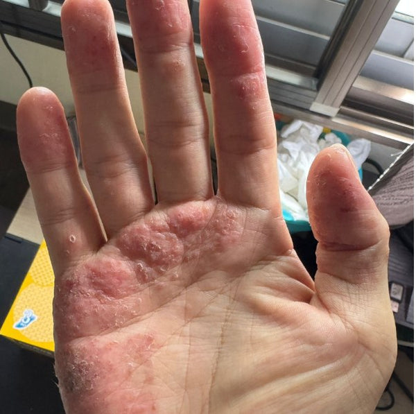 Before SpiroPlus — flared palm