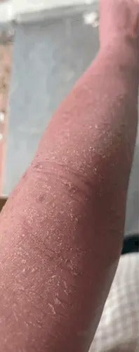 Inner & Outer Elbow eczema, before SpiroPlus