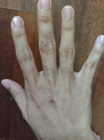 Back of hand eczema, after SpiroPlus