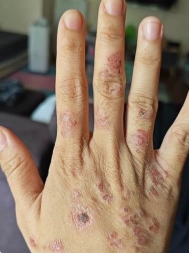 Back of hand eczema, before SpiroPlus