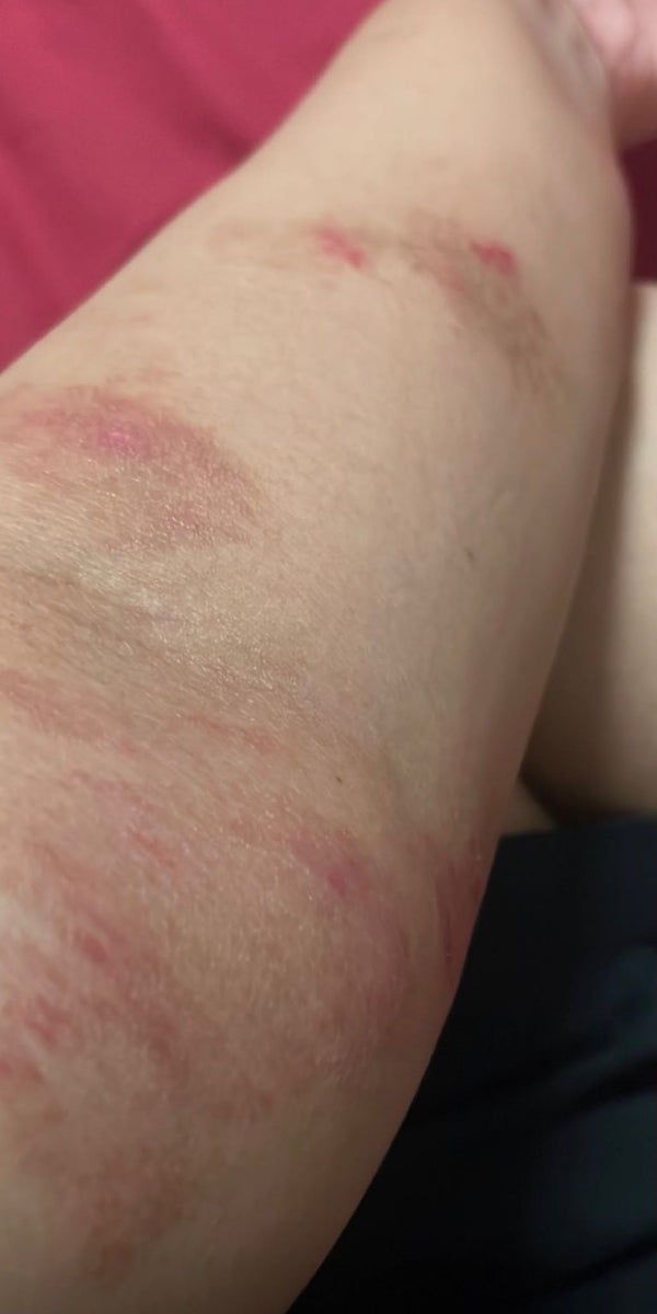 Forearm eczema, before SpiroPlus