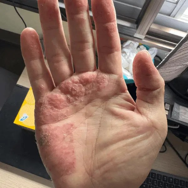 Palm eczema, before SpiroPlus