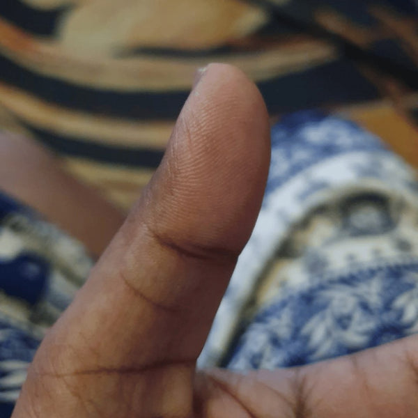 Thumb eczema, after SpiroPlus