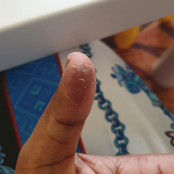 Thumb eczema, before SpiroPlus