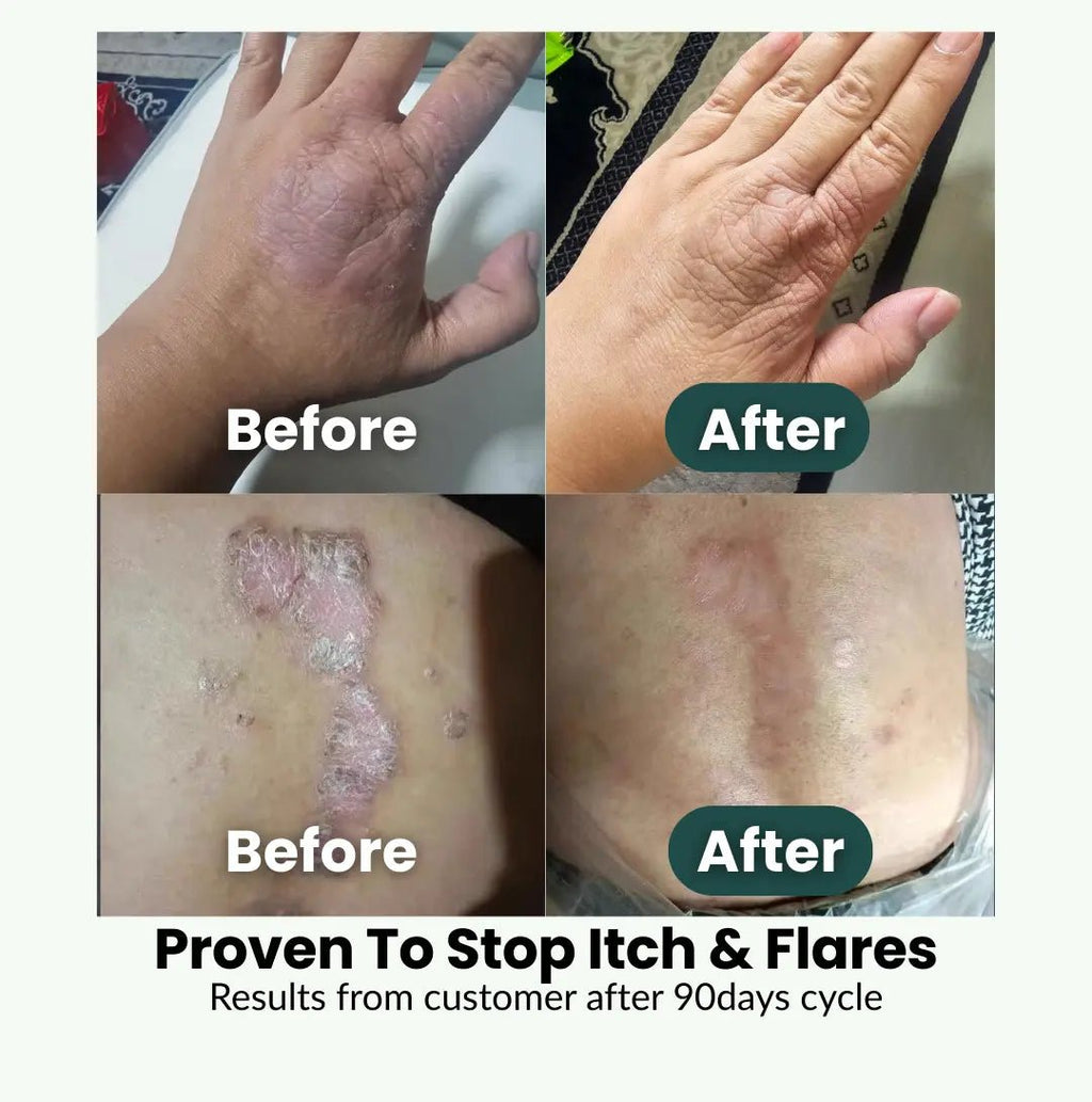 SpiroPlus (Eczema Solution Backed by Gut Science) - MakeHealth - Easier