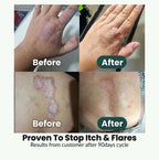 SpiroPlus (Eczema Solution Backed by Gut Science) - MakeHealth - Easier