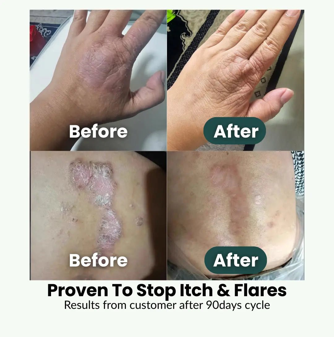 SpiroPlus (Eczema Solution Backed by Gut Science) - MakeHealth - Easier