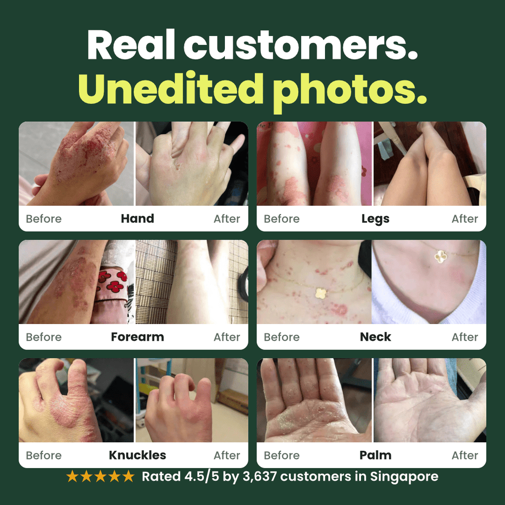 SpiroPlus (Eczema Solution Backed by Gut Science) - MakeHealth-Easier