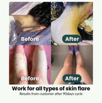 SpiroPlus (Eczema Solution Backed by Gut Science) - MakeHealth - Easier