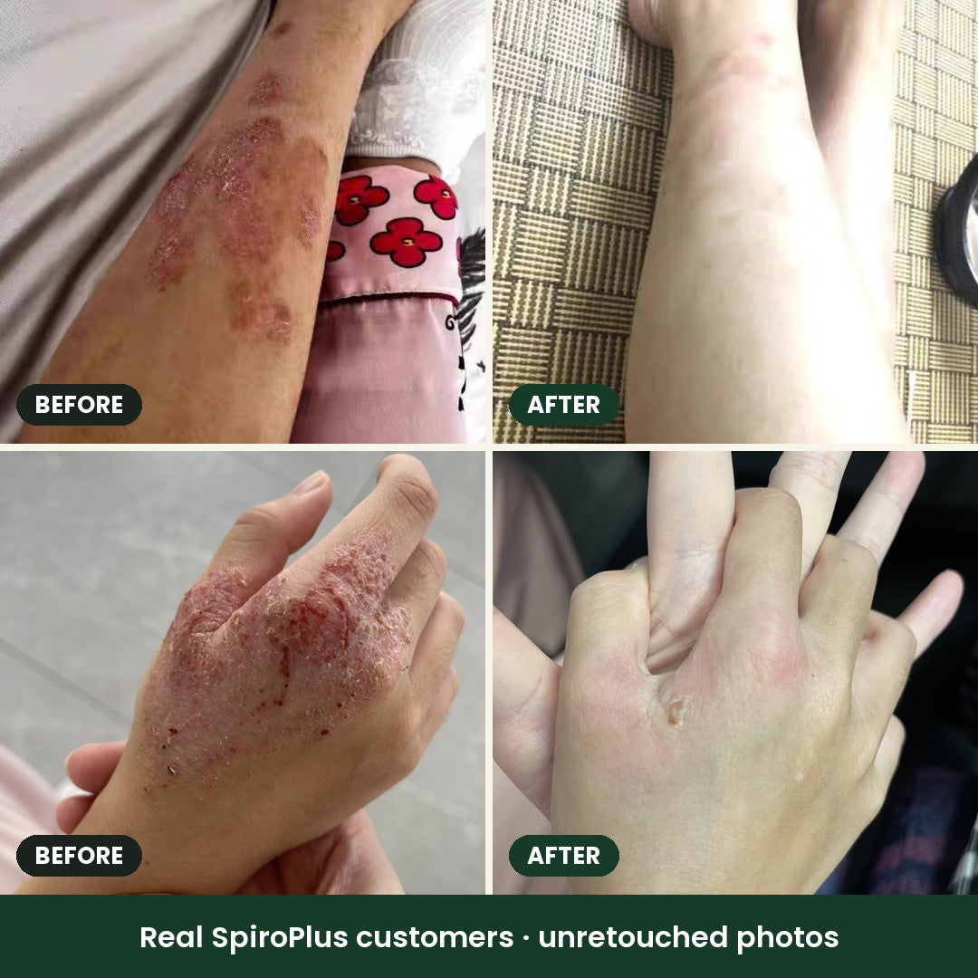 You Stop The Steroids. Your Eczema Comes Back. 5 Reasons Why, And How Singaporeans Are Slowly Getting Off Them For Good