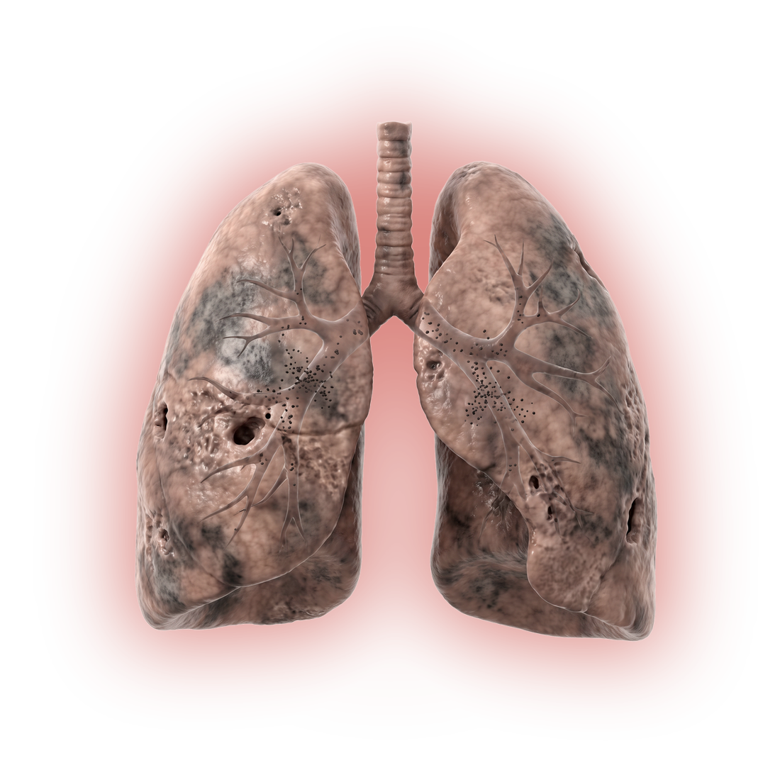3D lungs damaged by haze: soot staining, holes in the tissue and PM2.5 particles lodged in the airways